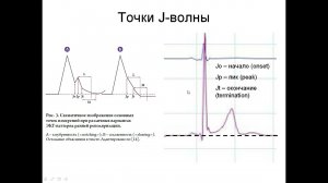 Ранняя реполяризация желудочков на ЭКГ
