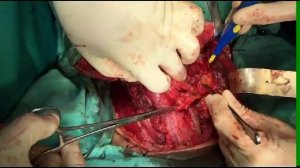 Prof. Aziz Aliyev. Thyroid With Lymph Node Cancer
