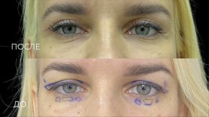 До и после круговой блефаропластики