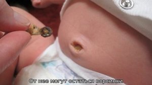 Пупок у новорожденного — сроки заживления пупочной ранки