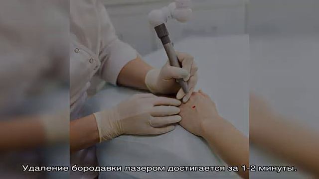 Удаление бородавок лазером - цены в Москве
