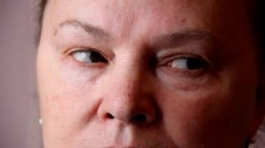 Вертикальный нистагм при повреждении мозжечка.