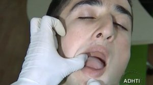 анестезия нижнего альвеолярного по егорову...anesthesia of the inferior alveolar nerve Yegorov