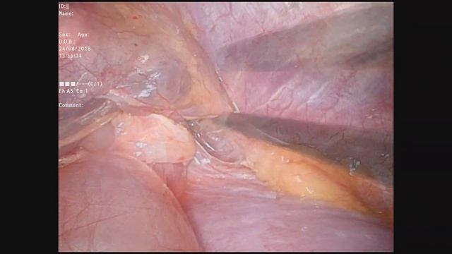 ВАТС однопортовое удаление целомической кисты перикарда (РНЦХ) смотреть онлайн