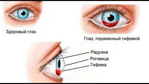 Что делать при кровоизлиянии в глазу