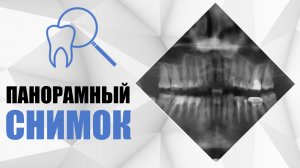 Панорамный снимок в стоматологии. Ортопантомография. Когда делать снимок?