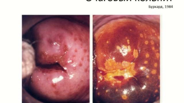 Гаджиева Т.С. Место кольпоскопии смотреть онлайн