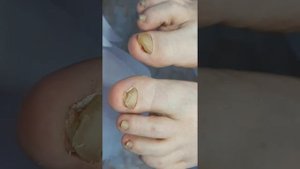 Протезирование ногтей , Унгизан. Ониходистрофия у женщины более 10 лет