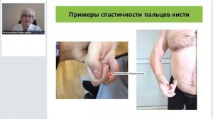 Роль и место ботулинотерапии в лечении и реабилитации пациентов с фокальной спастичностью.mp4