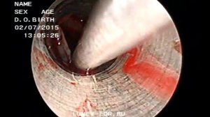 Удаление полипов и кисты верхнечелюстной пазухи 020715