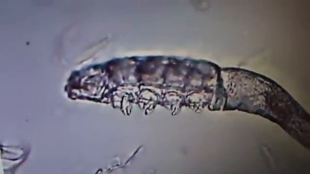 Demodex Mange вокруг глаз смотреть онлайн