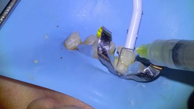 [5] Live root canal procedure on infected tooth смотреть онлайн