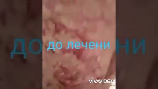 Псориаз излечим!!! Алоэ вера ЛР