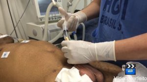 Cateterismo Vesical de Demora - Técnica com Retificação da Uretra