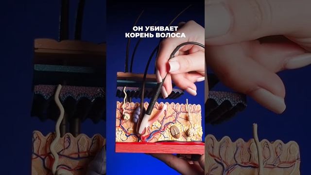 а название метода - электроэпиляция смотреть онлайн