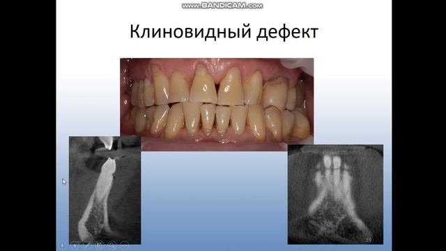 Лучевая диагностика кариеса и некариозных поражений