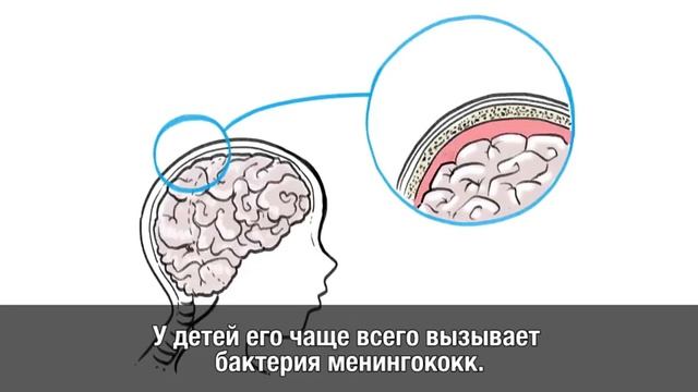 Что такое менингит и как его предотвратить смотреть онлайн