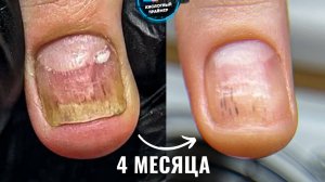 СНОВА ОНИХОЛИЗИС ногтей на руках! ЗАЧИСТКА №3!