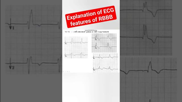 Explanation of the ECG features of RBBB #ecg