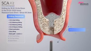 SCA Kit｜Sinus lift   Crestal approach with bone graft｜Procedure Neobiotech