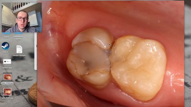 клинический случай #16 восстановление зубов пломбами длительного ношения перед ортодоксией смотреть онлайн