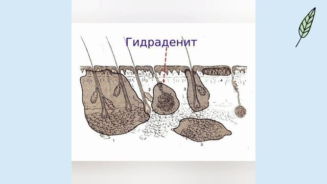 Гидраденит