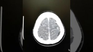 Метастазы в головной мозг (мскт признаки)