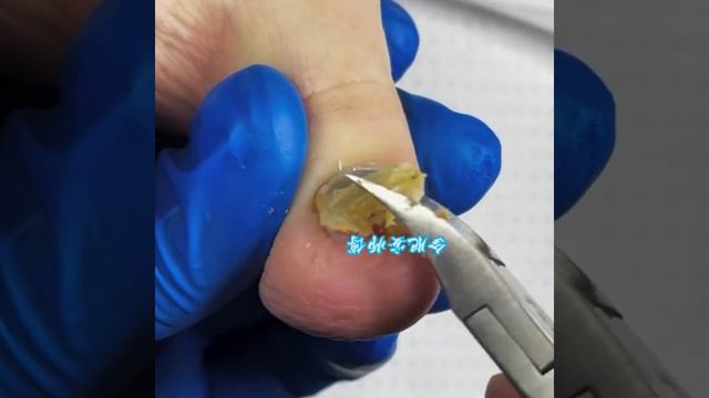 The Whole Process Of Super Thick Onychomycosis Repair#magicknife