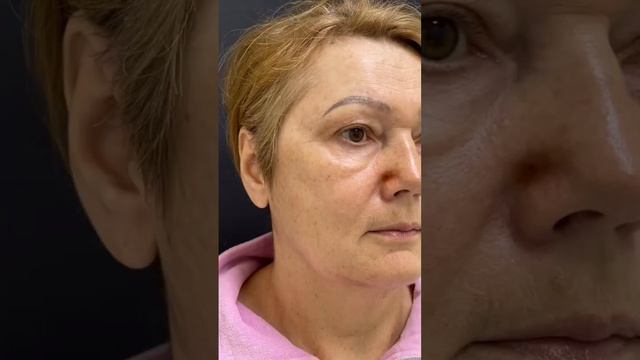 Пациентке 5 месяцев назад была выполнена круговая блефаропластика. Хирург - Загидат Магомедовна смотреть онлайн