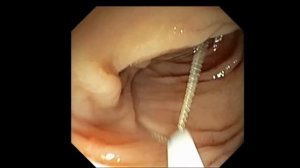 Эндоскопическое удаление полипов толстой кишки