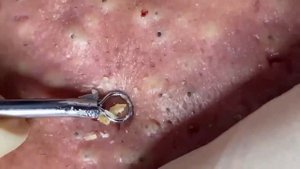 blackheads New this week 2023