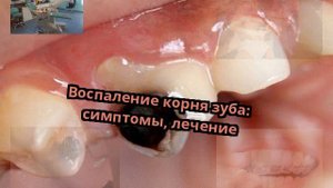 Воспаление корня зуба: симптомы, лечение