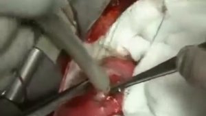 ШОК! Ленточные черви в сердце. Паразитические ленточные черви у человека