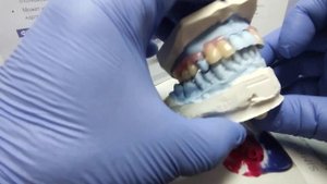 Зубной протез из термопласта