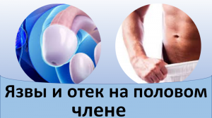 Язвы и отек на половом члене