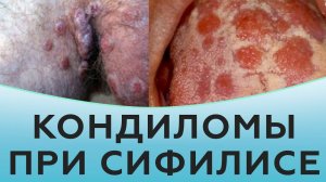 Кондиломы при сифилисе