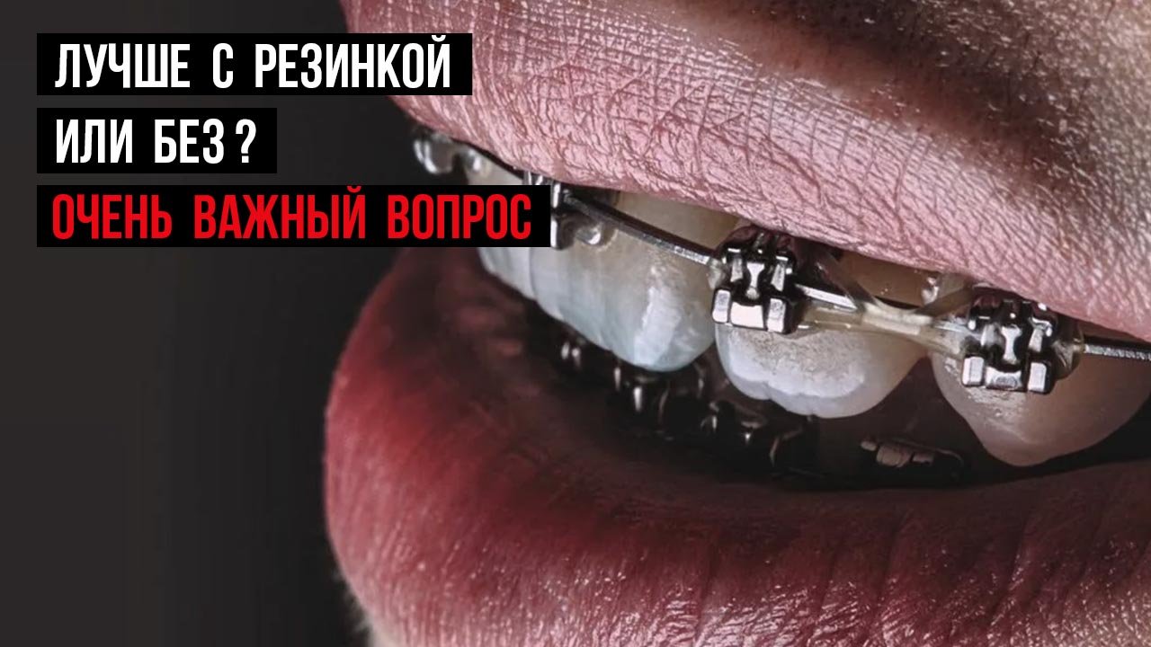 Какие брекеты лучше❓Лигатурная или безлигатурная брекет-система.