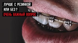 Какие брекеты лучше❓Лигатурная или безлигатурная брекет-система.