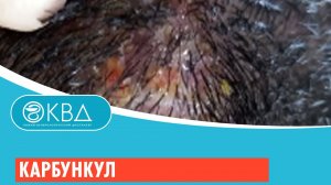 Карбункул. Клинический случай №87
