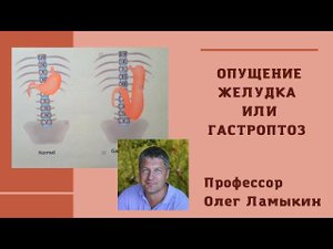 Опущение желудка или Гастроптоз. Проф. Ламыкин О.Д.