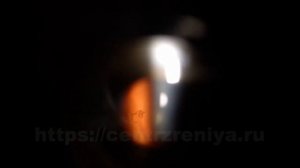 Задняя отслойка стекловидного тела