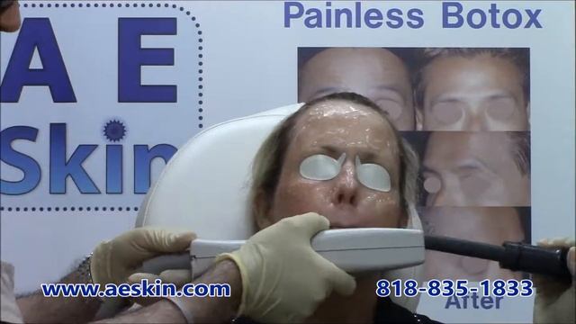 Forever Young BBL IPL Photofacial Demonstration 12 - A E Skin - Encino, CA - 818-835-1833 смотреть онлайн