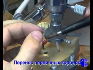 Этапы изгтовления бюгельных протезов (часть 2)