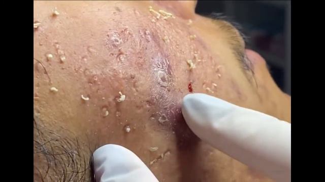 Remoção de cravo 2021 - Pimple Popping 2021 -Blackhead Removal  EP0013