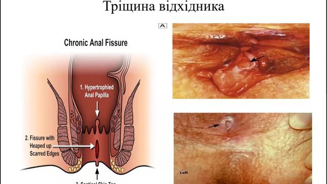 Анальна тріщина. Гостра /хронічна тріщина відхідника
