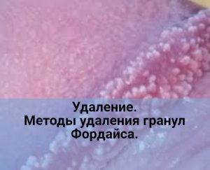 Методы удаления гранул Фордайса на головке полового члена