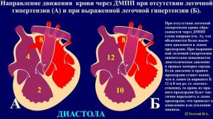 Тема 45.1. Врожденные пороки сердца – дефект межпредсердной перегородки (ДМПП)