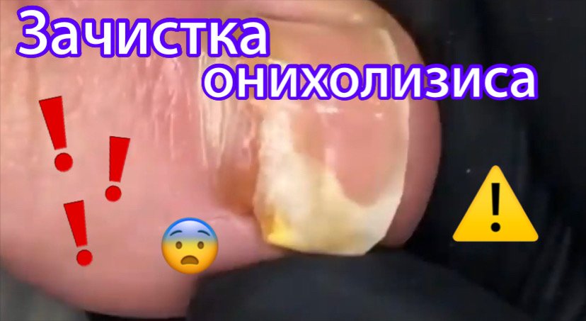 Зачистка онихолизиса ⚠️???
