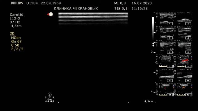 БЦА s УЗИ сосудов шеи в Уссурийске в клинике Чехрановых смотреть онлайн