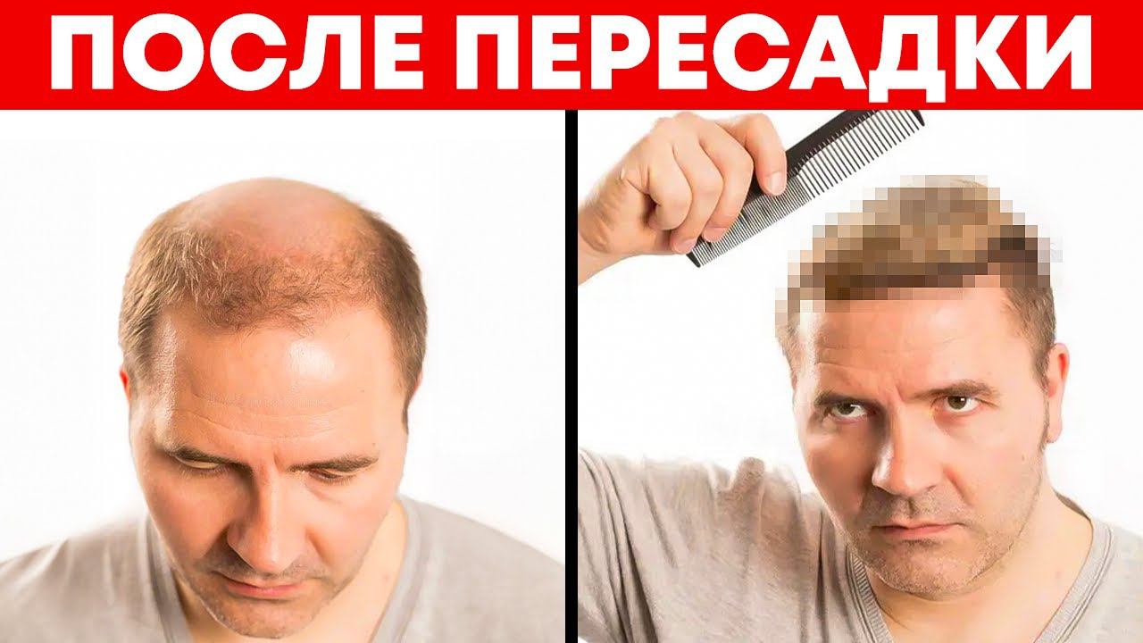 Что вас ждёт после пересадки волос | Александр Долгов